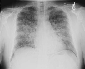 High Altitude Pulmonary Oedema X-ray Chest