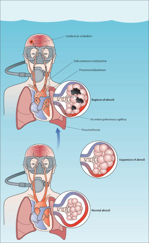 Decompression illness - Pulmonary barotrauma resulting in CAGE